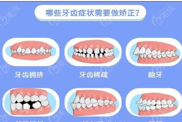 牙齿矫正大概要花费多少钱，金属牙套6至8千(全流程1至5万不等) ！-第1张图片